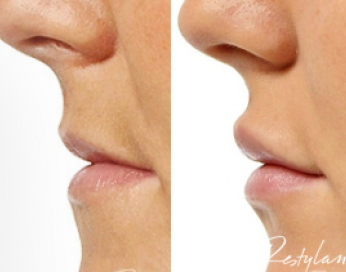 lappforstoring_foe-1